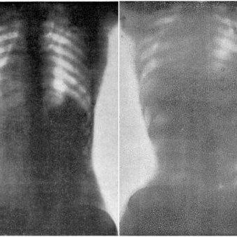 Doctor O’Followell’s X-rays of women wearing corsets: 1908